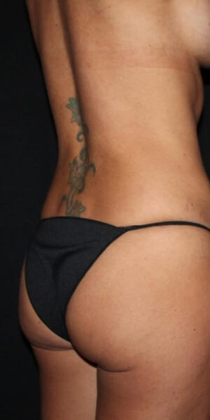 Brazilian Butt Lift Before and After Gallery