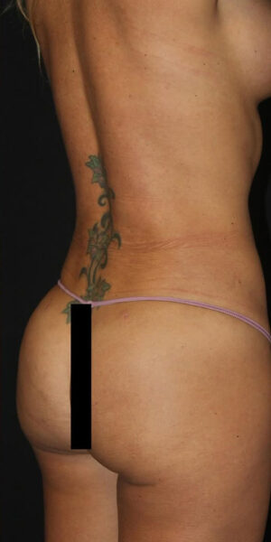 Brazilian Butt Lift Before and After Gallery