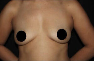 Breast Augmentation Before and After Gallery