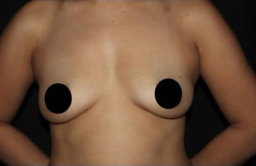 Breast Augmentation Before and After Gallery