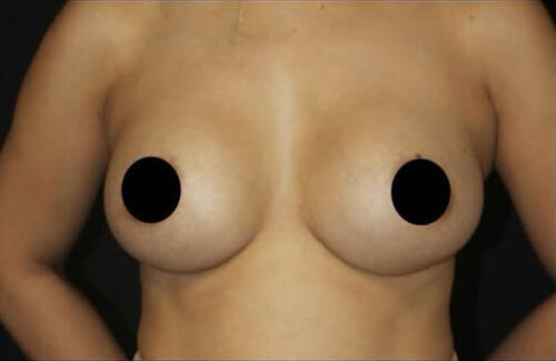 Breast Augmentation Before and After Gallery
