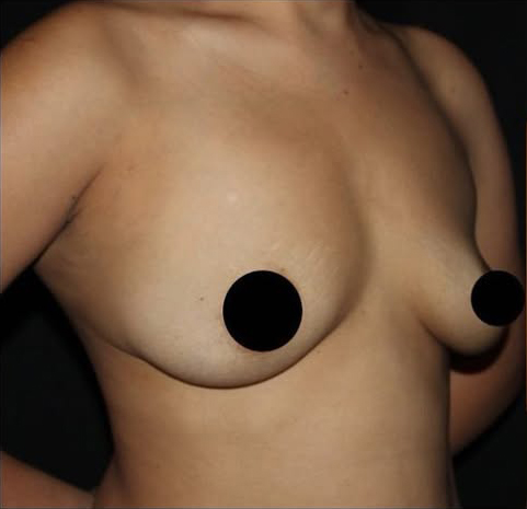 Breast Augmentation Before and After Gallery