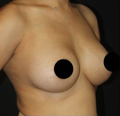 Breast Augmentation Before and After Gallery