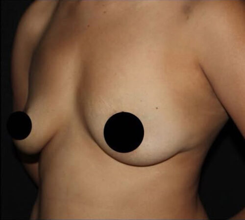 Breast Augmentation Before and After Gallery