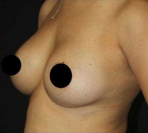 Breast Augmentation Before and After Gallery