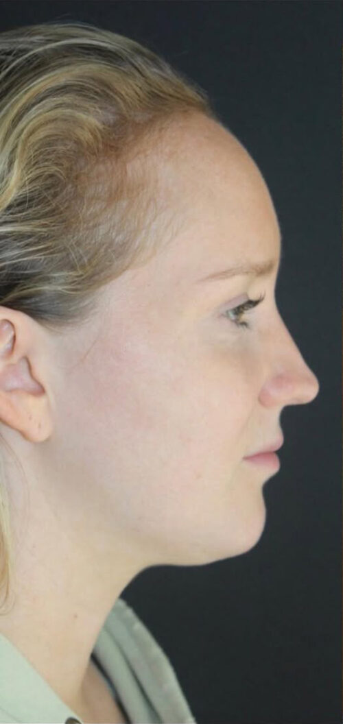 Rhinoplasty Before and After Gallery