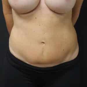 Tummy Tuck Before and After Gallery