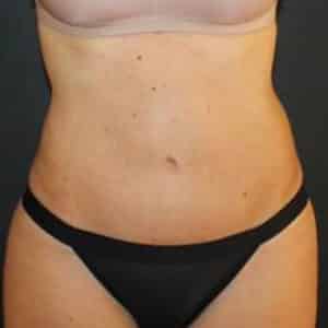Tummy Tuck Before and After Gallery