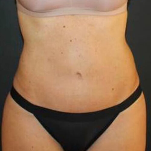 Tummy Tuck Before and After Gallery