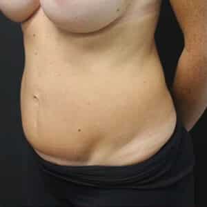 Tummy Tuck Before and After Gallery