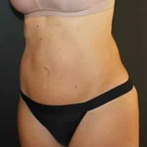 Tummy Tuck Before and After Gallery
