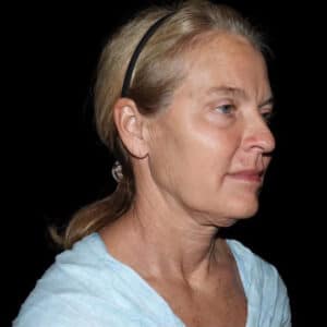 Face and Necklift Before and After Gallery