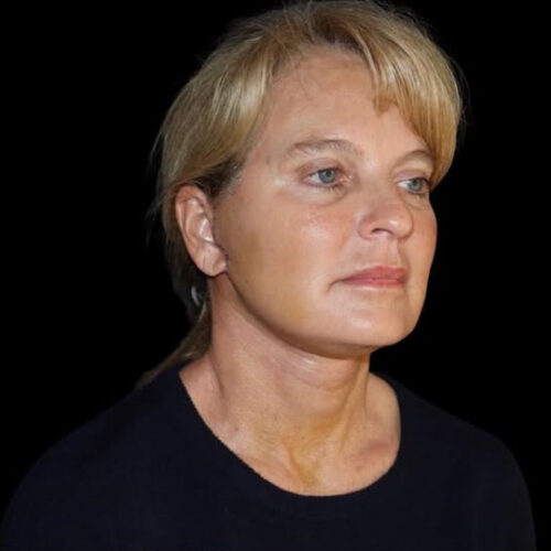 Face and Necklift Before and After Gallery