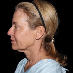 Face and Necklift Before and After Gallery