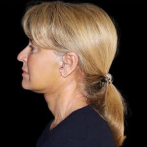 Face and Necklift Before and After Gallery