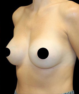 Breast Augmentation Before and After Gallery