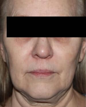 Face and Necklift Before and After Gallery