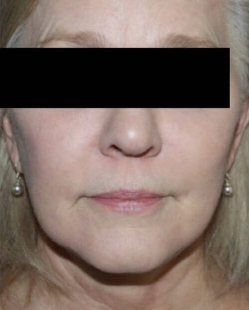 Face and Necklift Before and After Gallery
