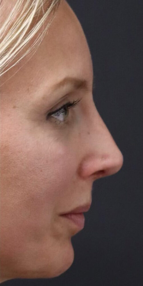 Rhinoplasty Before and After Gallery