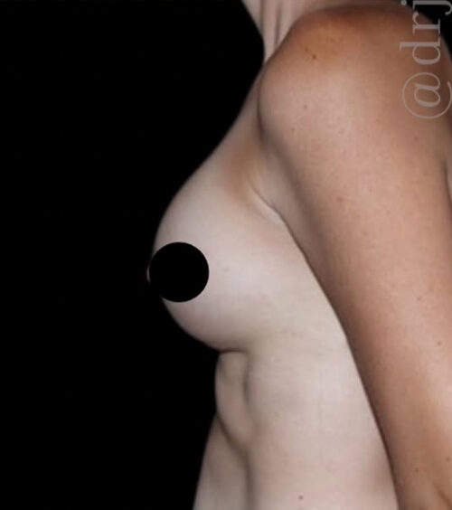 Breast Augmentation Before and After Gallery
