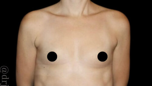 Breast Augmentation Before and After Gallery