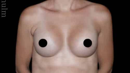 Breast Augmentation Before and After Gallery