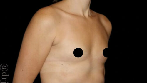 Breast Augmentation Before and After Gallery