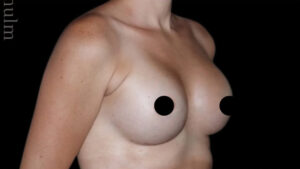 Breast Augmentation Before and After Gallery