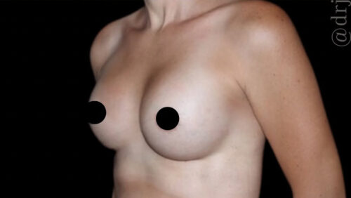 Breast Augmentation Before and After Gallery