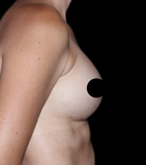 Breast Augmentation Before and After Gallery