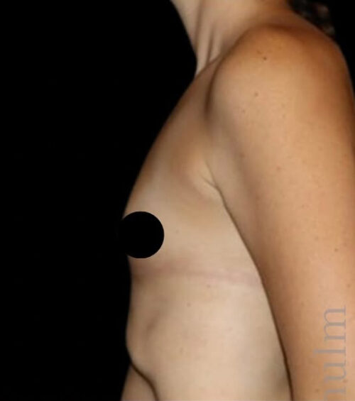 Breast Augmentation Before and After Gallery