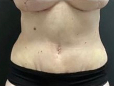 Mommy Makeover Before and After Gallery