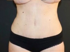 Mommy Makeover Before and After Gallery