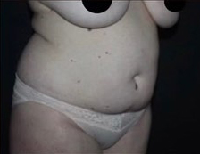 Mommy Makeover Before and After Gallery