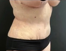 Mommy Makeover Before and After Gallery