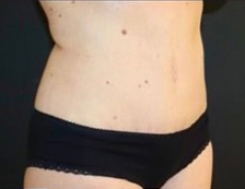 Mommy Makeover Before and After Gallery