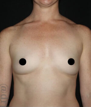 Breast Augmentation Before and After Gallery