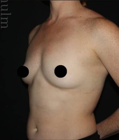 Breast Augmentation Before and After Gallery