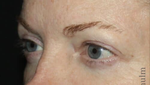 Eyelid Surgery Before and After Gallery