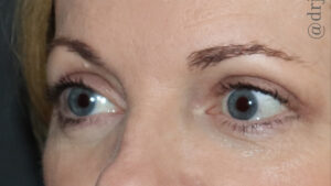 Eyelid Surgery Before and After Gallery