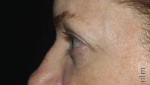 Eyelid Surgery Before and After Gallery