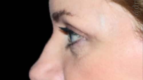 Eyelid Surgery Before and After Gallery