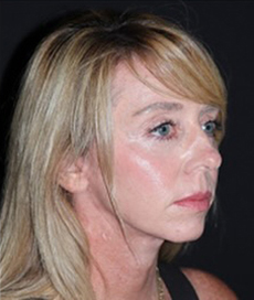 Face and Necklift Before and After Gallery