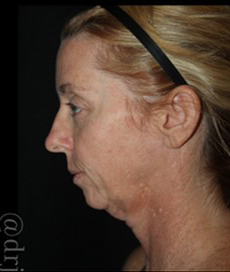 Face and Necklift Before and After Gallery