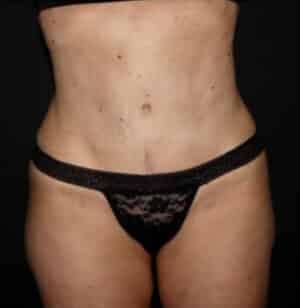 Tummy Tuck Before and After Gallery