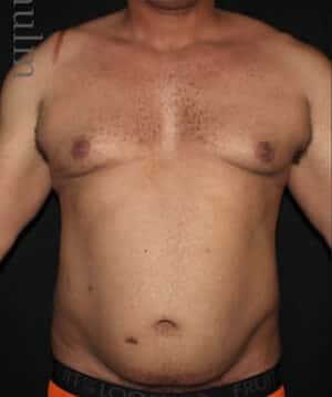 Liposuction Before and After Gallery