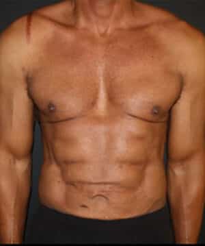 Liposuction Before and After Gallery