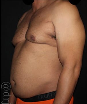 Liposuction Before and After Gallery