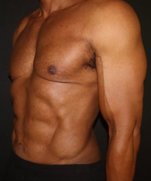 Liposuction Before and After Gallery