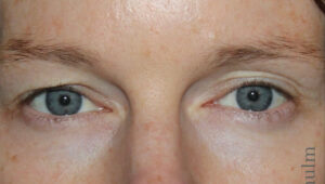 Eyelid Surgery Before and After Gallery